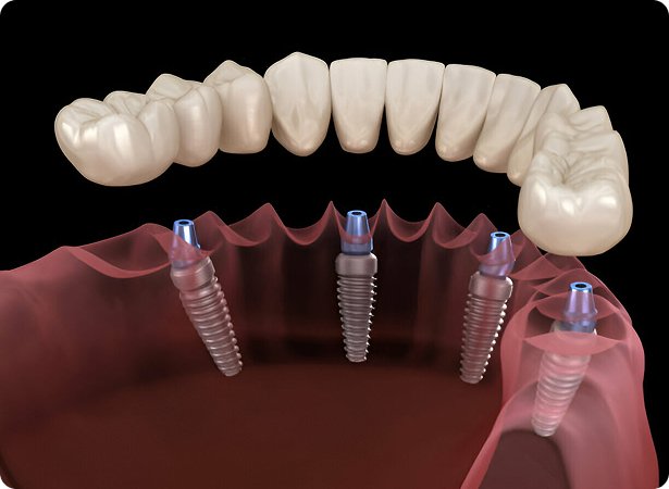 Implants Dentaires & All-on-X